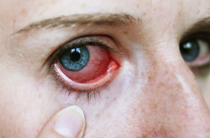 Hero_Article_EnUK_Conditions-Uveitis