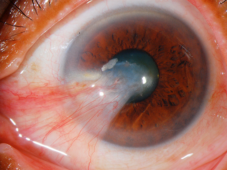 Pterygium surgery